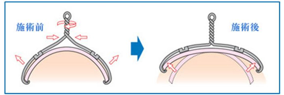 コレクティオワイヤー法